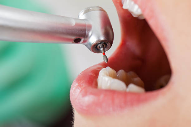 Best Emergency Treatment for Dental Infections or Abscesses in Fort Denaud, FL